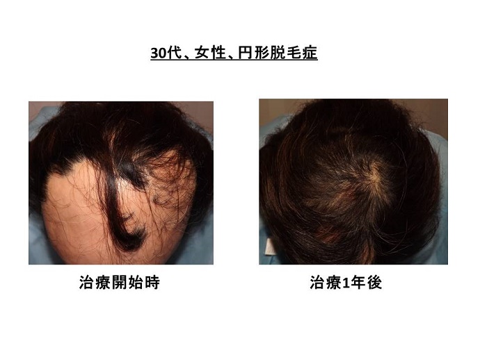 円形脱毛症　病院""